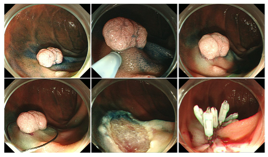 表在性非乳頭部十二指腸腫瘍に対するOTSC®併用内視鏡的粘膜切除術