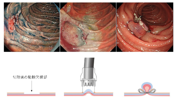 表在性非乳頭部十二指腸腫瘍に対する内視鏡的粘膜下層剥離術(ESD)とOTSC®を用いた切除後潰瘍底の完全閉鎖