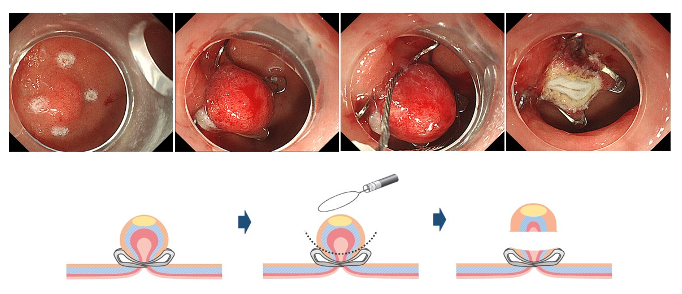 表在性非乳頭部十二指腸腫瘍に対する内視鏡的粘膜下層剥離術(ESD)とOTSC®を用いた切除後潰瘍底の完全閉鎖