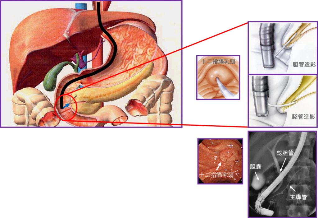 内視鏡的逆行性膵胆管造影