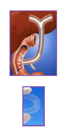 内視鏡的胆管ドレナージ術2