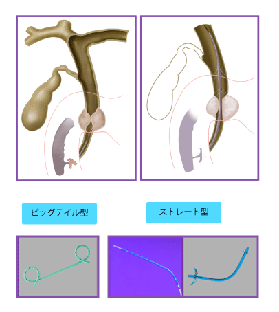 内視鏡的胆管ドレナージ術1