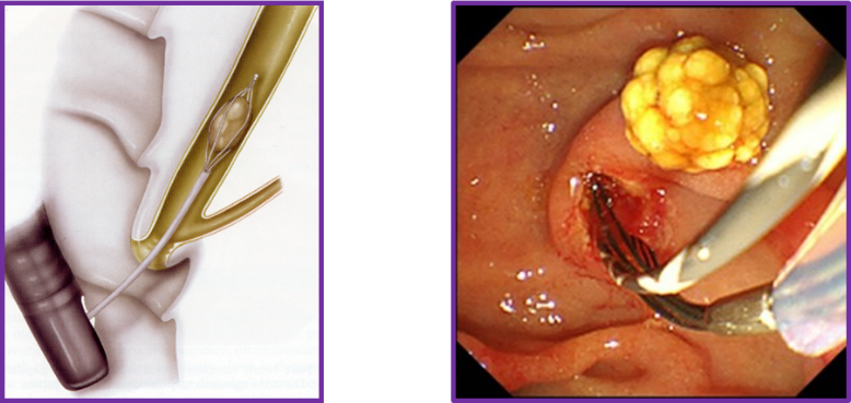 内視鏡的胆管結石除去術