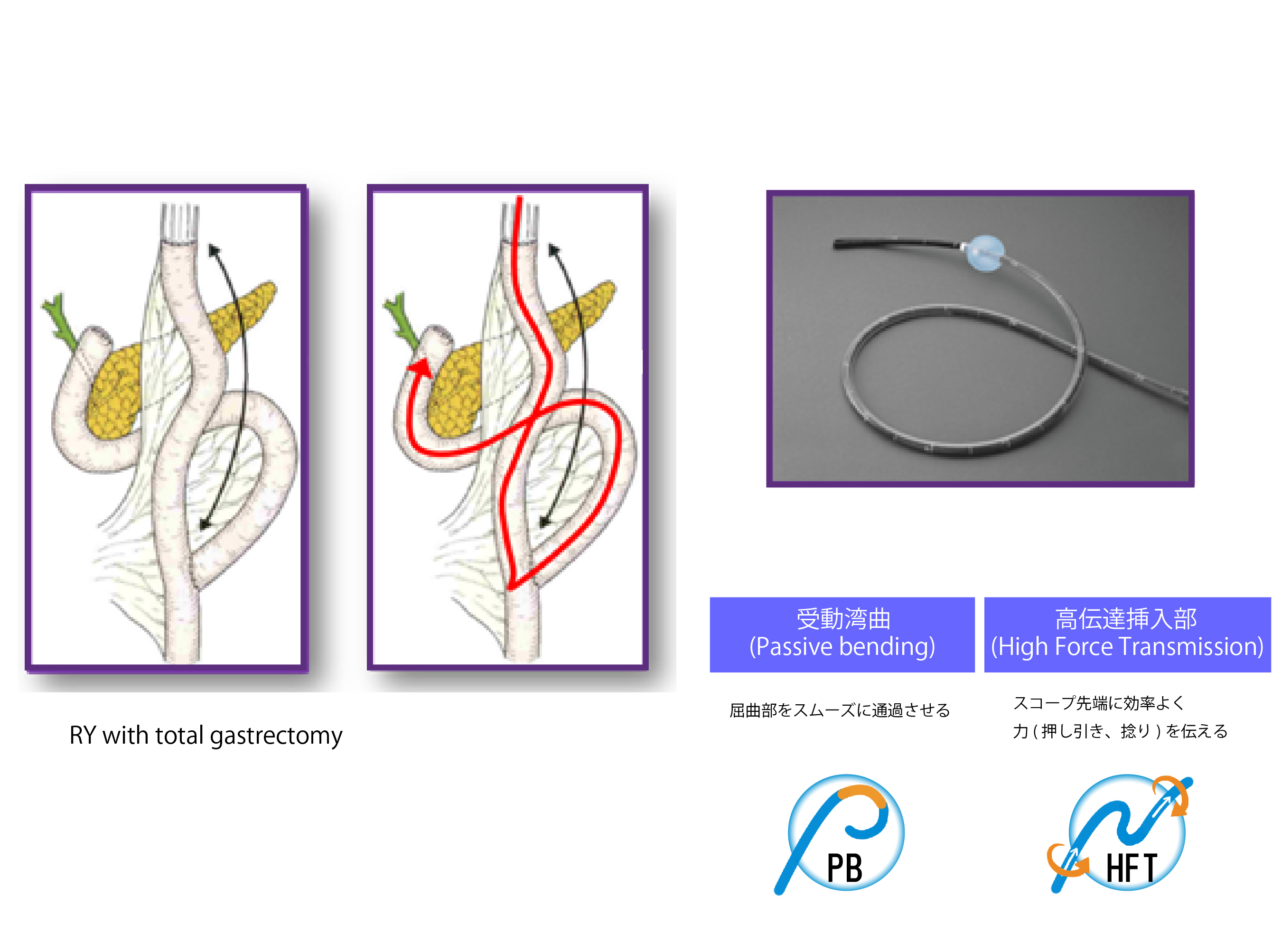 術後腸管症例へのERCP