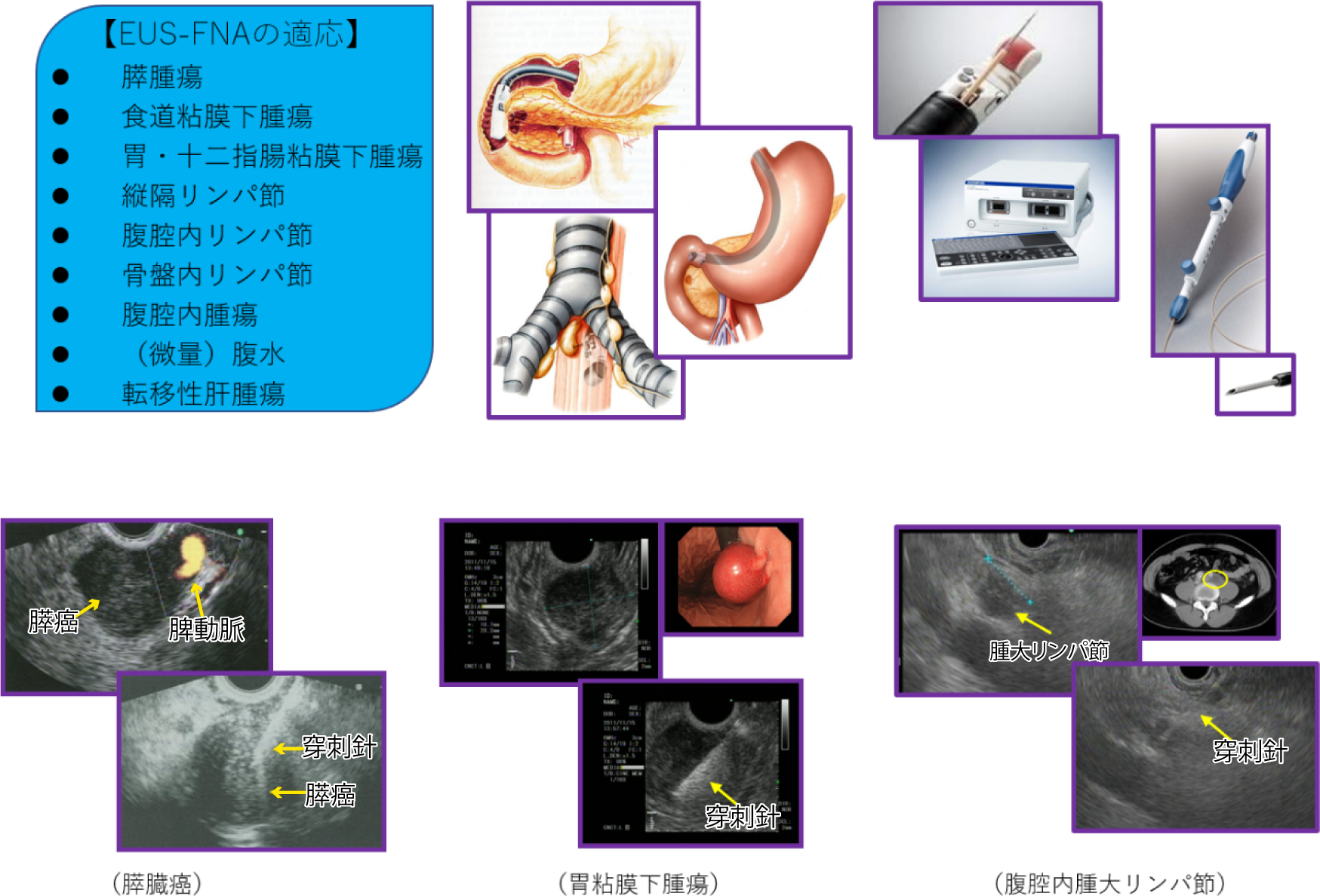 超音波内視鏡下穿刺吸引術