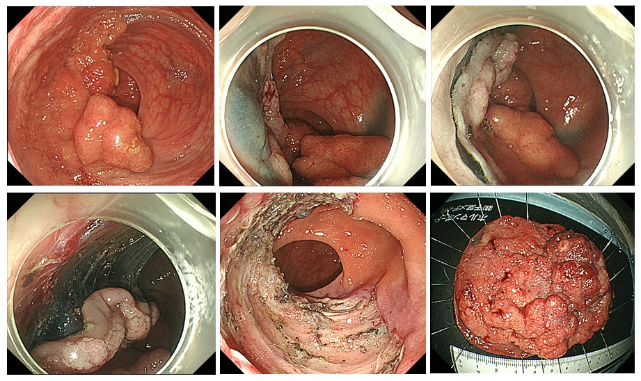 大腸がんに対する内視鏡的粘膜下層剥離術(ESD)