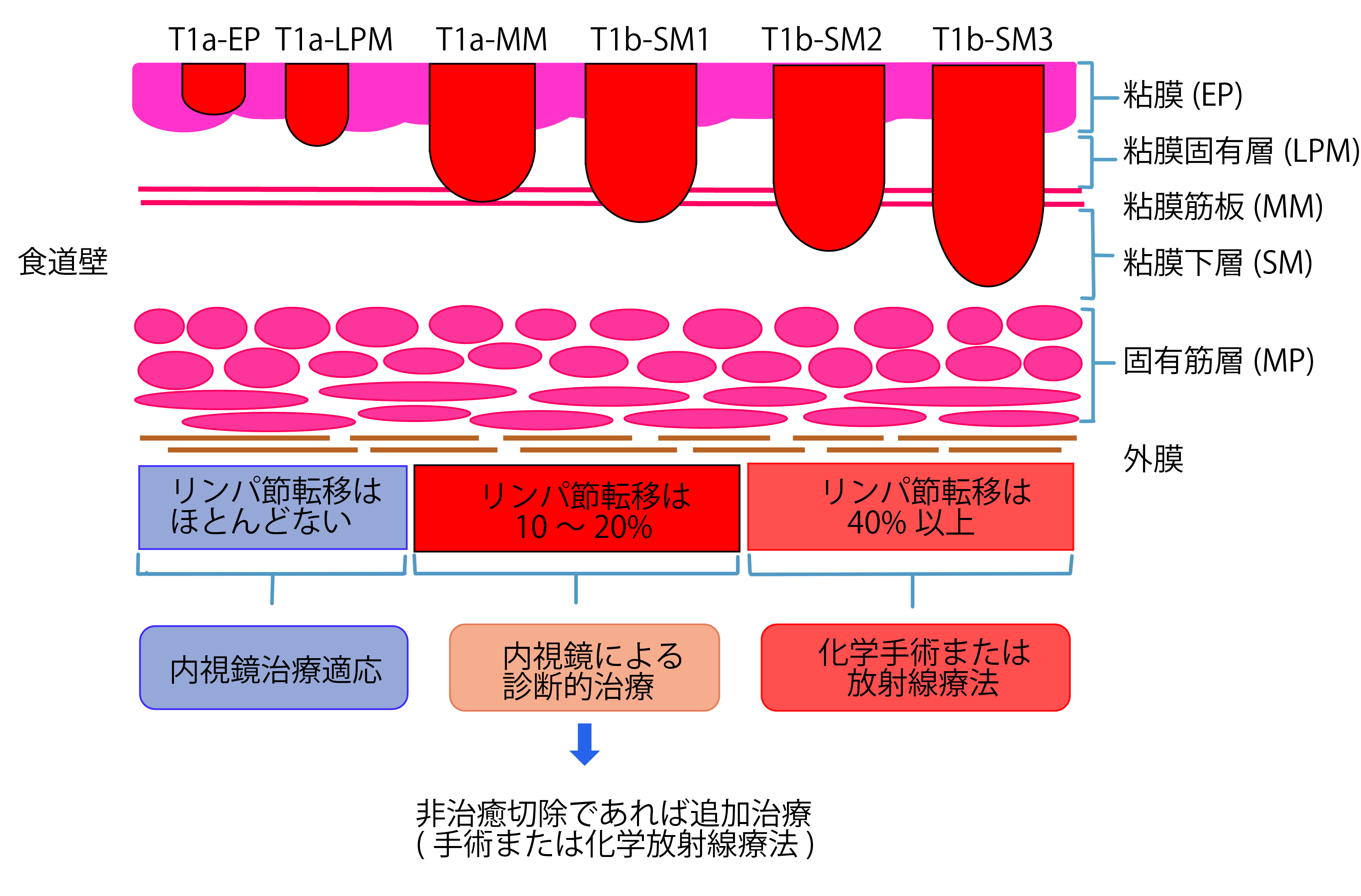 食道がんの内視鏡治療の適応1