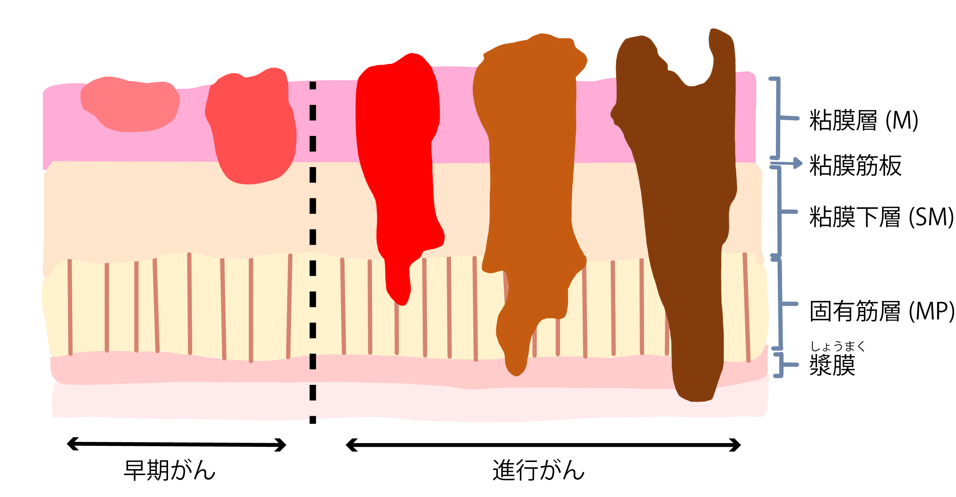 腫瘍の深さ（深達度）と進行の程度