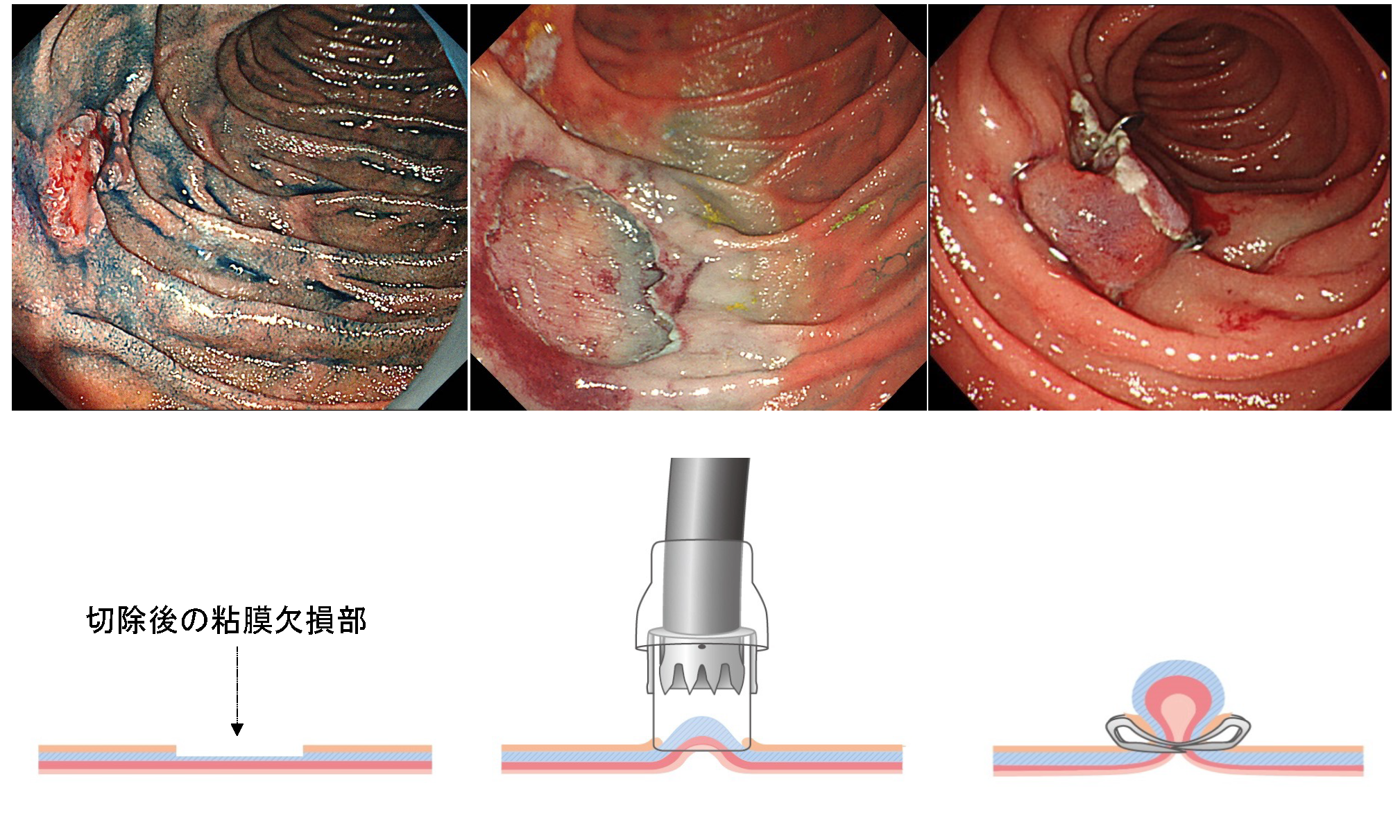 消化管グループの内視鏡治療の特徴 | 埼玉医科大学国際医療センター ...