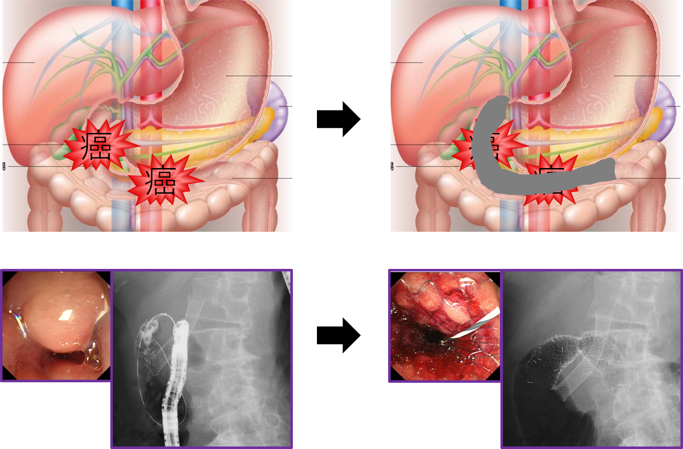 内視鏡的消化管ステント留置術